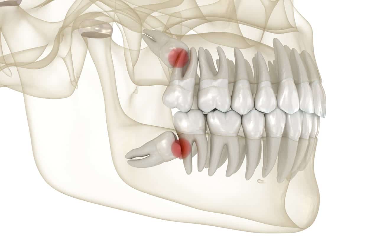 Dr. Spandana's Dentistry Wisdom Teeth Extraction recovery - Dr. Spandanas Dentistry best dentist for wisdom teeth removal in hyderabad