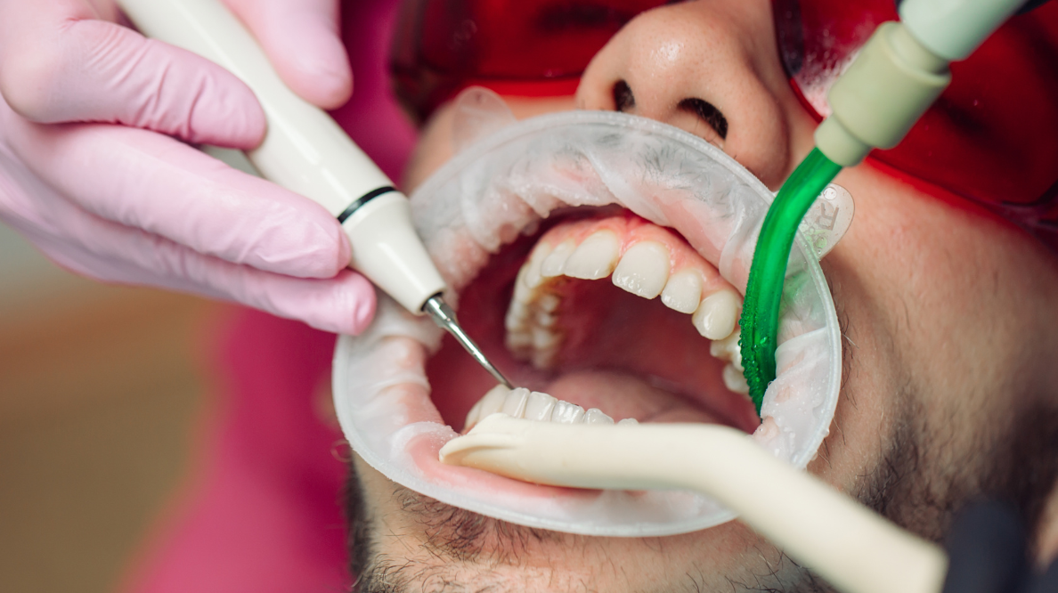 Teeth dont heal - Dr. Spandanas Dentistry - Dr. Spandanas Dentistry Dentist drills a patient’s upper teeth while suction tube and protective eyewear are in place.