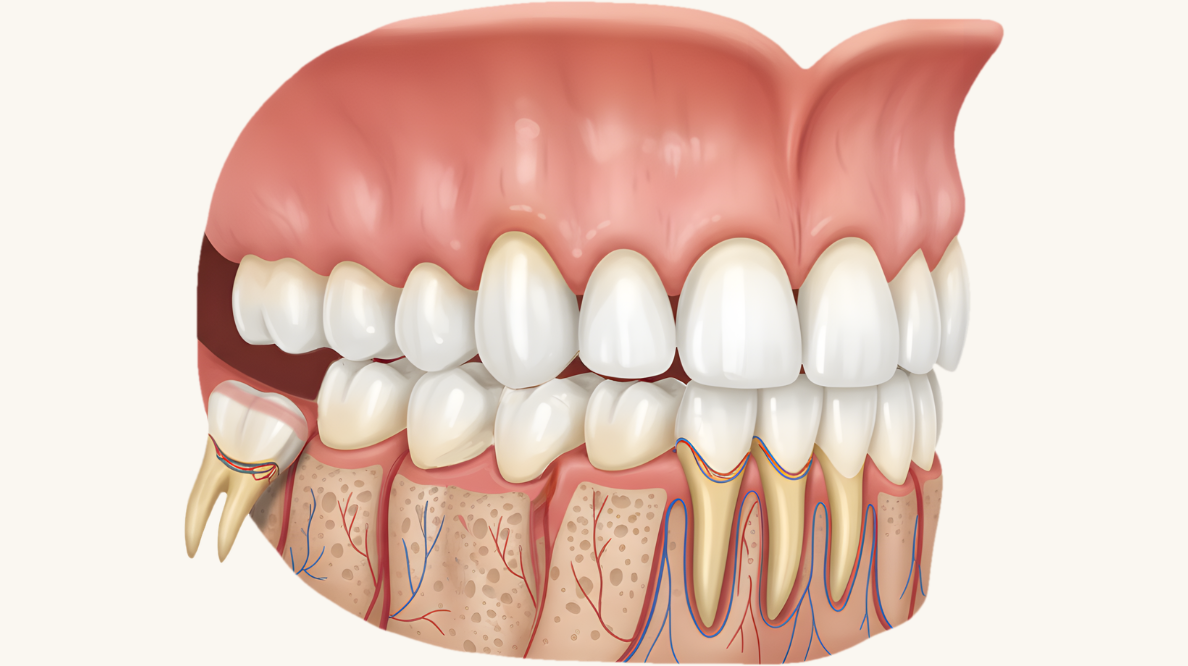 Wisdom tooth - Dr. Spandanas Dentistry Side cross-section of a human mouth showing teeth, gums, and jawbone with nerves and blood vessels; a missing lower-left molar.