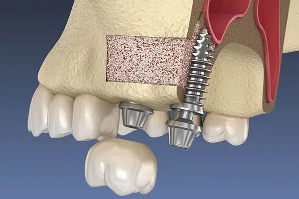 Dr. Spandana's Dentistry Expert in Dental Implants, Pediatric Dentistry, Bonegraft
