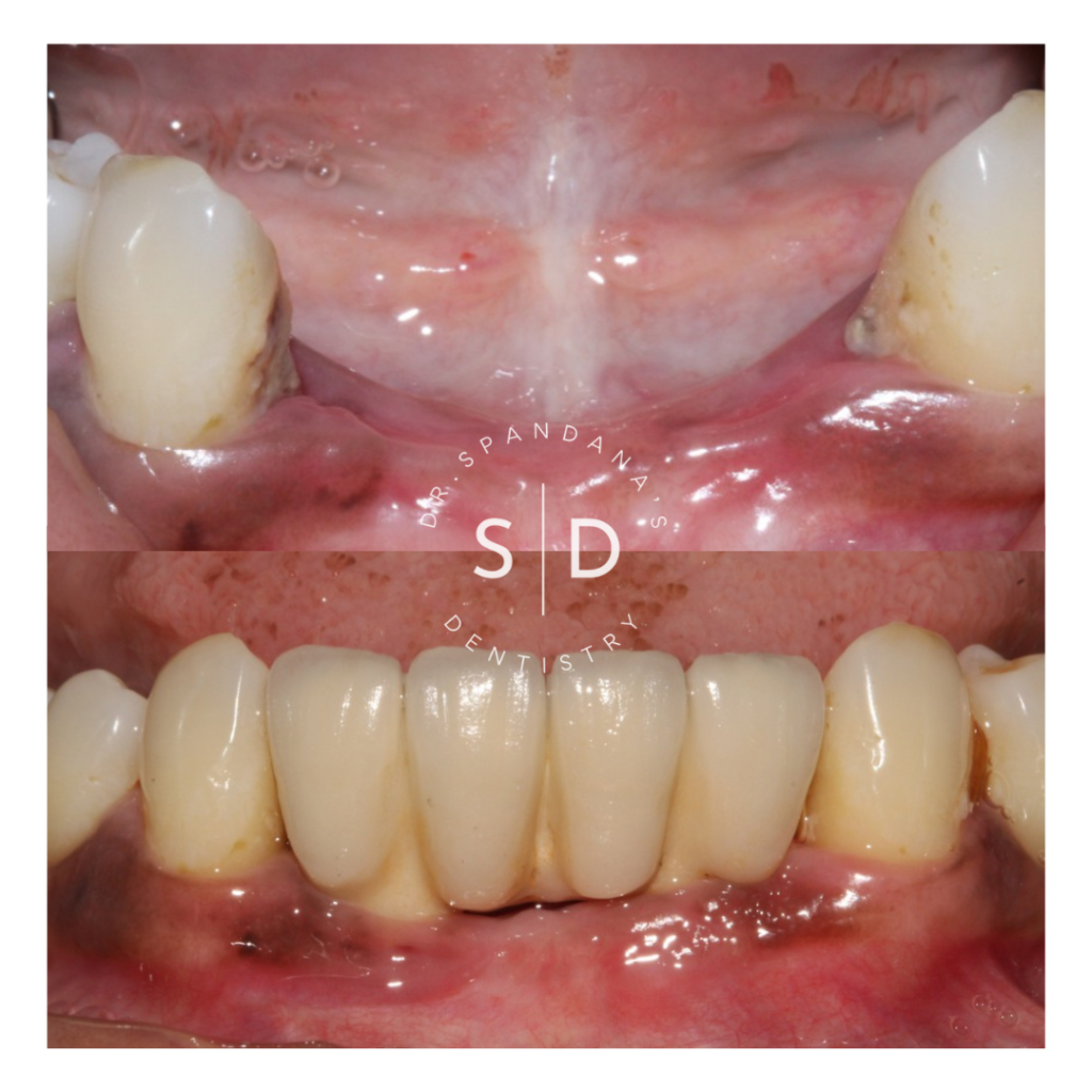 Dr. Spandana's Dentistry, Dental implant before/after images Best dental implantologist in Hyderabad