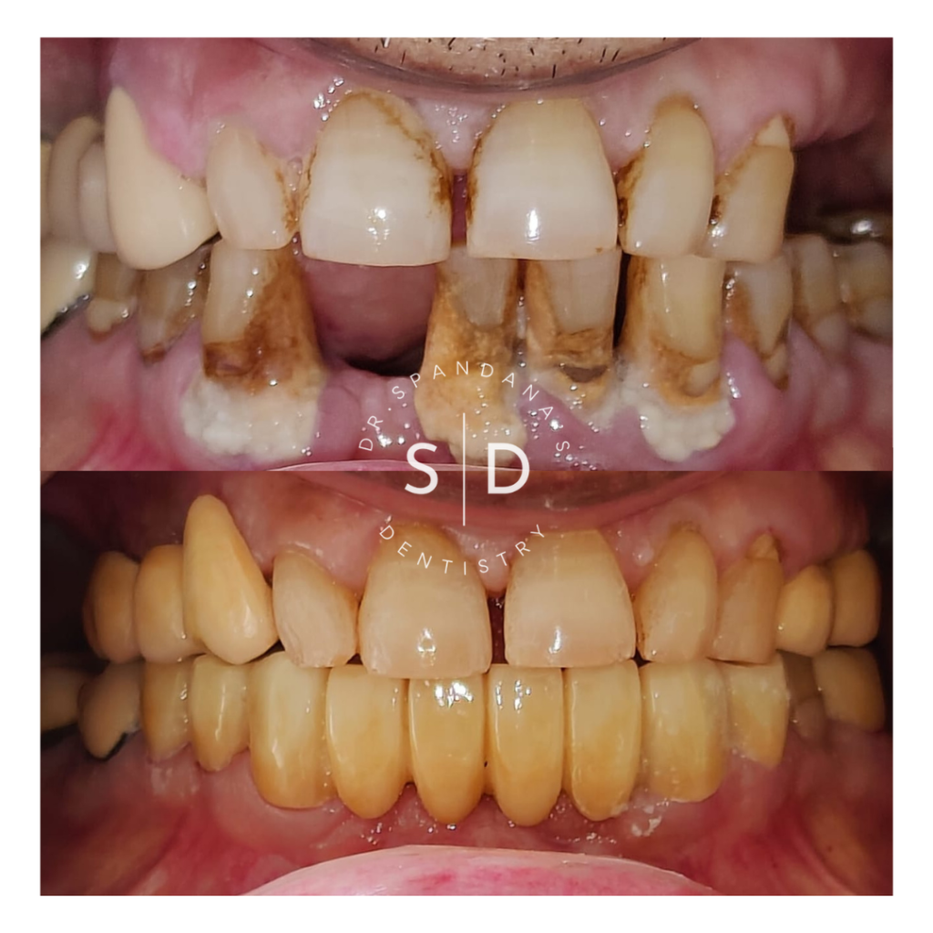 Dr. Spandana's Dentistry, Missing Tooth treatments in Hyderabad