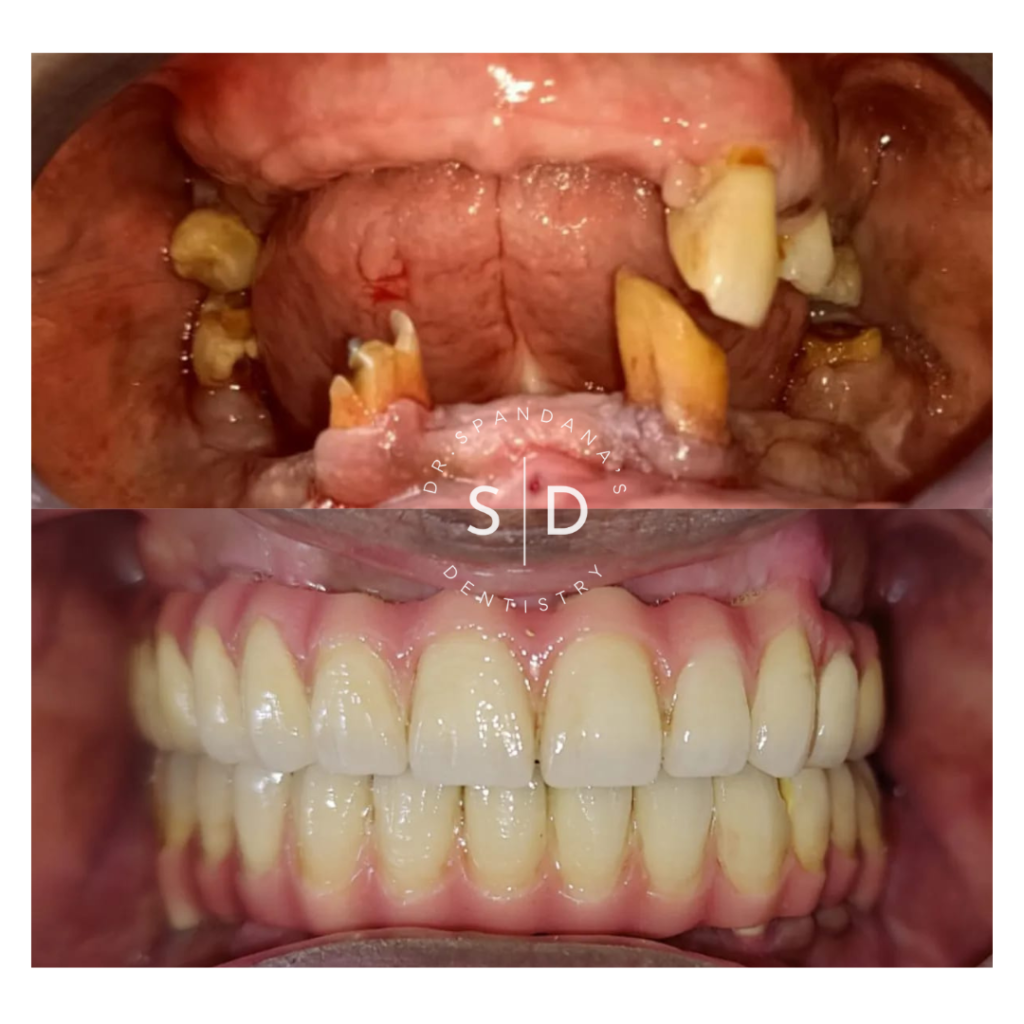 missing tooth? Dental implants are the best option for you