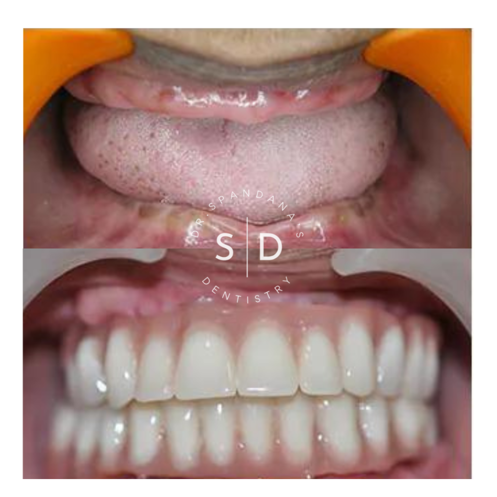 Dr.Spandana's Dentistry - Best dental implant clinic in Hyderabad Before/After Result