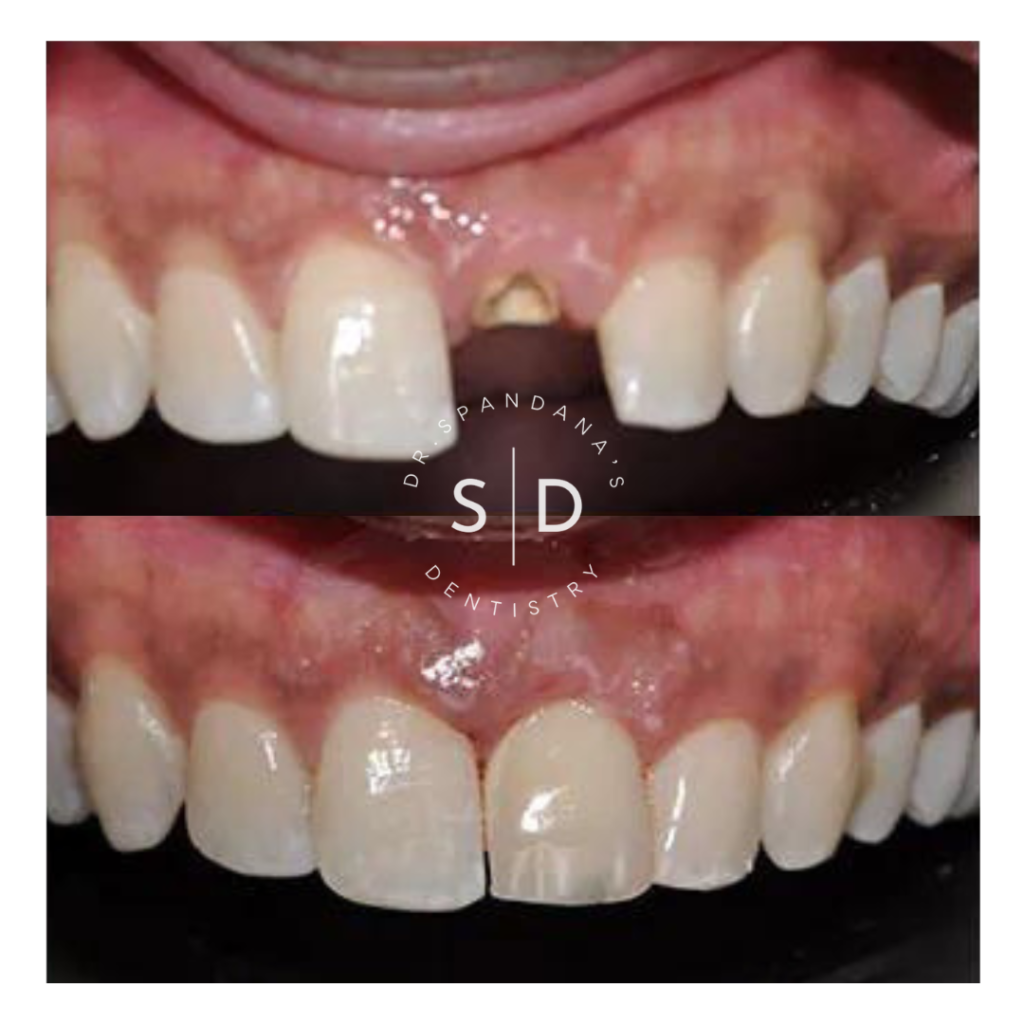 Dr.Spandana's Dentistry - Best Missing Tooth Correction Clinic in Hyderabad Before/After Results