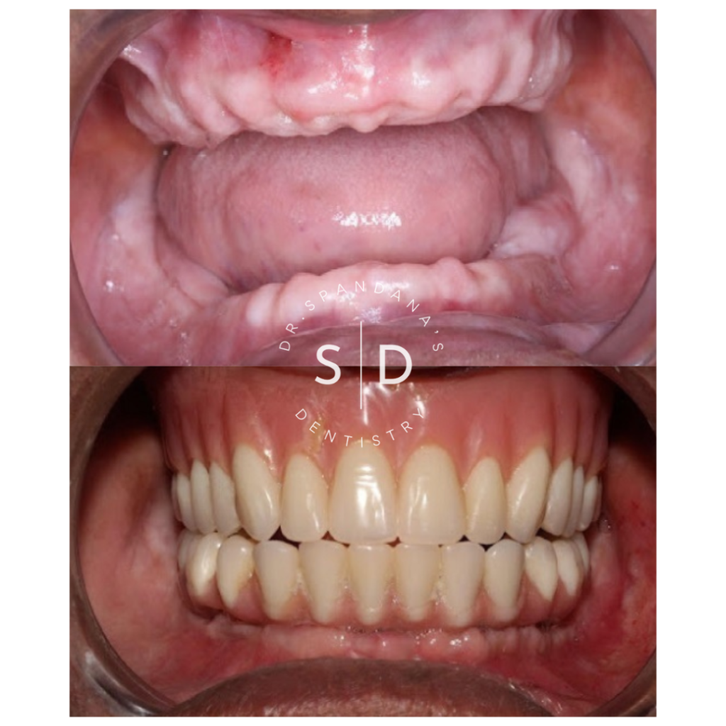 Dr.Spandana's Dentistry - Best Missing Tooth Correction Clinic in Hyderabad Before/After Results