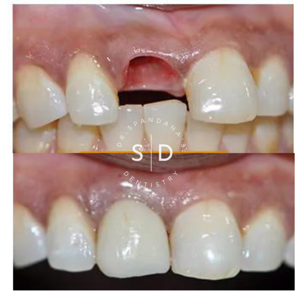 Before and after a single tooth dental implant replacing a missing upper front tooth.