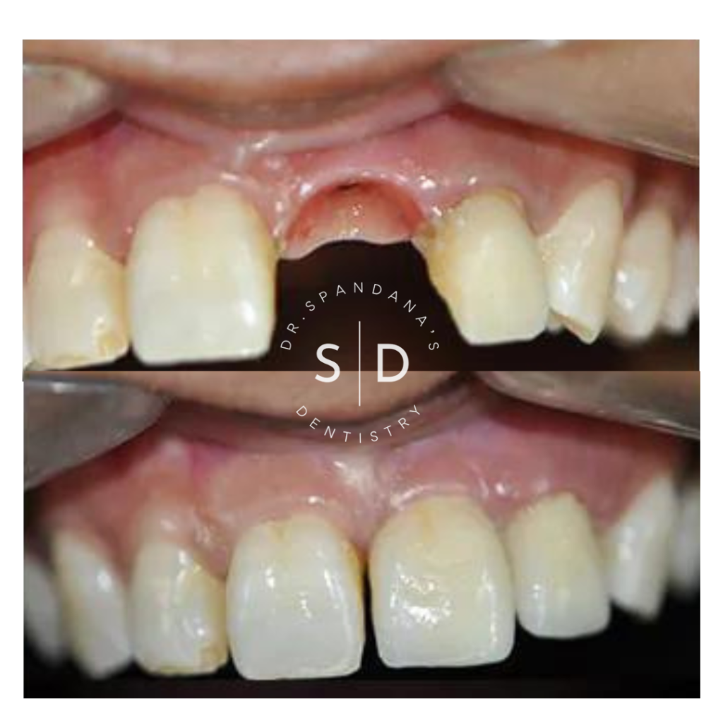 Dr.Spandana's Dentistry - Best Smile Correction Clinic in Hyderabad Before/After Results
