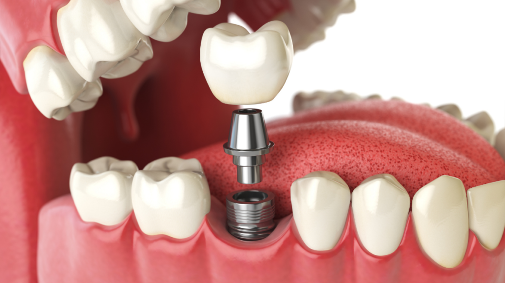 Dental implant procedure: a crown is positioned above a titanium abutment in the lower jaw.