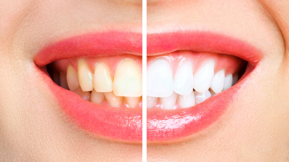 Split image showing a mouth with yellowed teeth on the left and bright white teeth after whitening on the right.