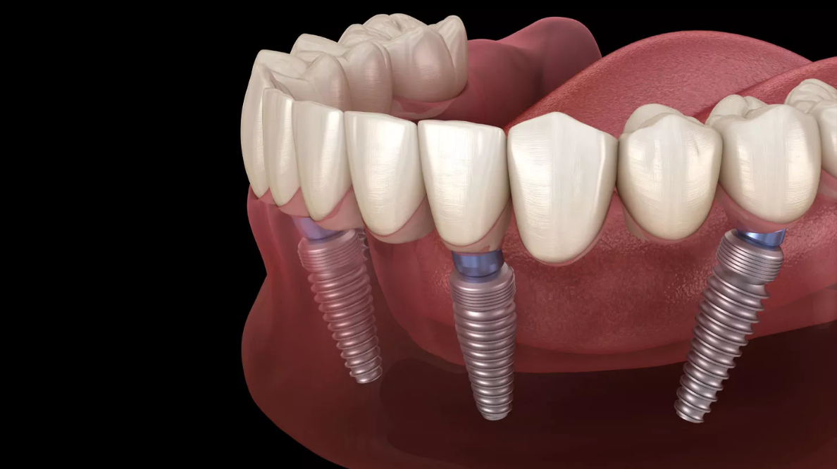 Lower jaw showing three dental implants with artificial teeth attached to abutments.
