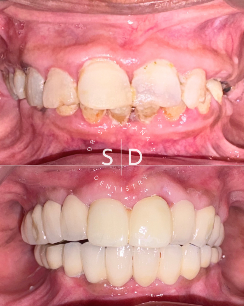 Get a free second opinion for dental implants