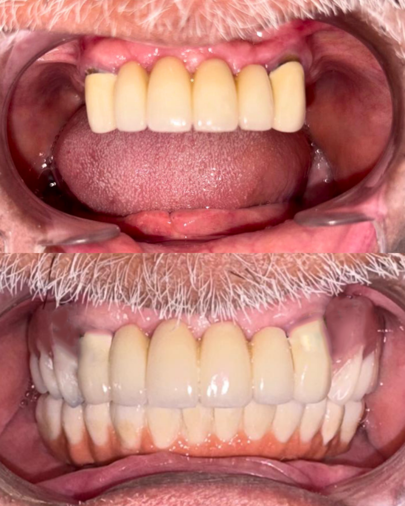 Before and after implant treatment replacing a missing upper front tooth