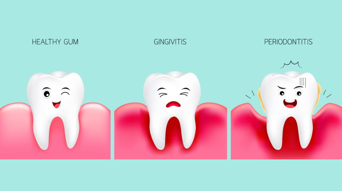 19 - Dr. Spandanas Dentistry - Dr. Spandanas Dentistry Three-panel infographic: healthy gum with a smiling tooth, gingivitis with a sad tooth, and periodontitis with a distressed tooth.