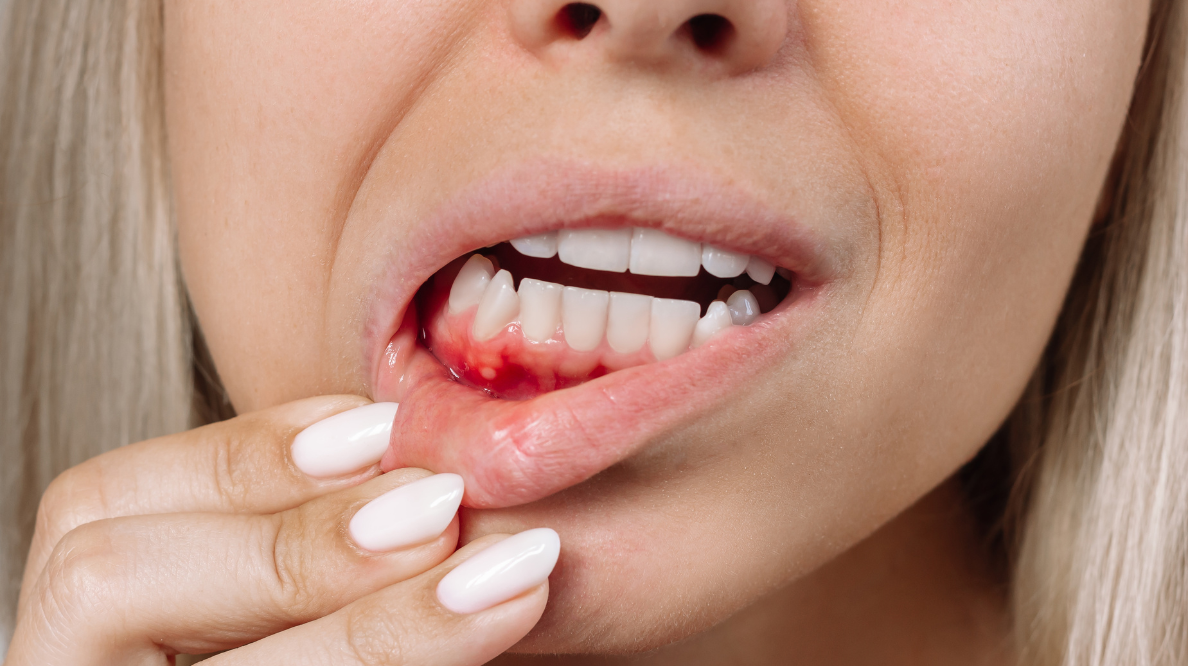 Hero image - Dr. Spandanas Dentistry - Dr. Spandanas Dentistry Close-up of a woman's mouth showing a bloody lower-lip injury while pulling the lip back to inspect it.