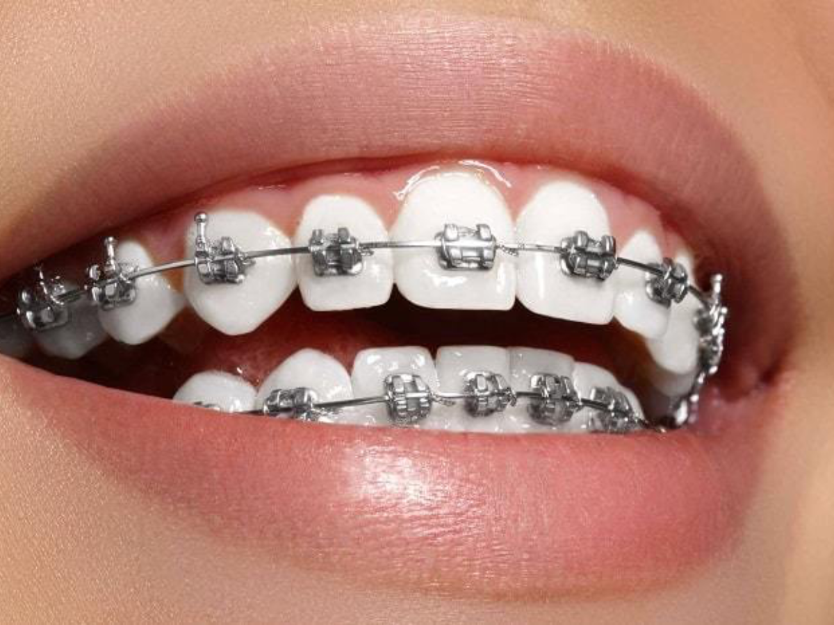Metal Braces
