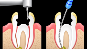 Cross-section of a tooth during root canal treatment: left side with drill creating an access cavity; right side with endodontic file cleaning the canal