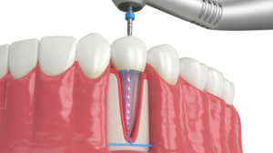 Cross‑section view of a dental implant procedure: a drill is preparing a socket in the jawbone beneath an adjacent tooth and gum tissue.