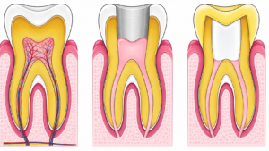 Three-panel dental cross-section: left—nerve vessels in pulp; center—exposed pulp with root canals; right—tooth with crown prep.