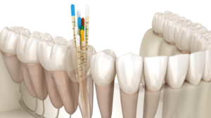 3D dental illustration showing multiple dental implant posts in the jaw between teeth, representing an implant-supported bridge.