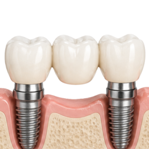 Three artificial teeth (a dental bridge) supported by two dental implants in the gums.
