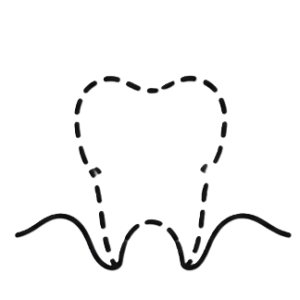 Illustration of a tooth with a dashed outline above a wavy line representing gums.