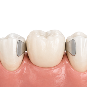Close-up of a dental model showing a natural centered tooth flanked by metal-ceramic crowns on adjacent teeth, with pink gingiva visible.