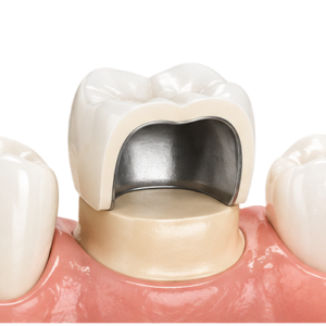 Dental model showing a tooth crown with a metal inner substructure on a pink gum-colored base.