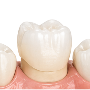 Dental crown placed on a pink gum model, illustrating a tooth prosthetic on a molar centerpiece