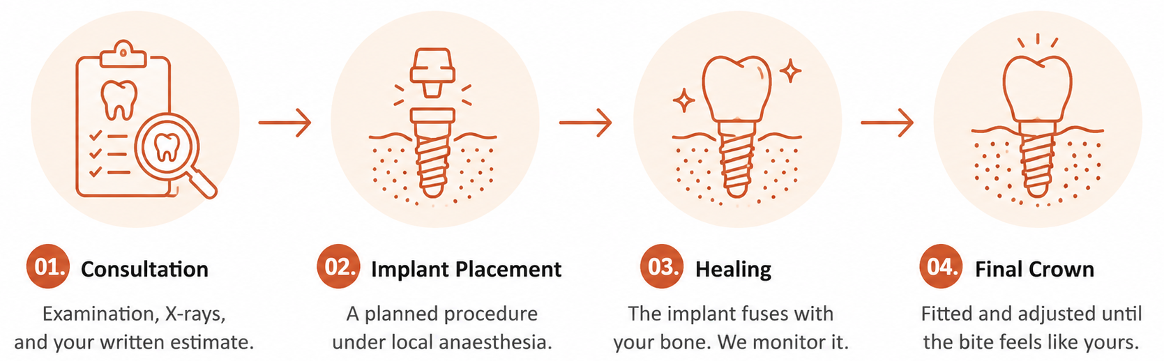 Graphic showing four dental implant steps: Consultation, Implant Placement, Healing, Final Crown.