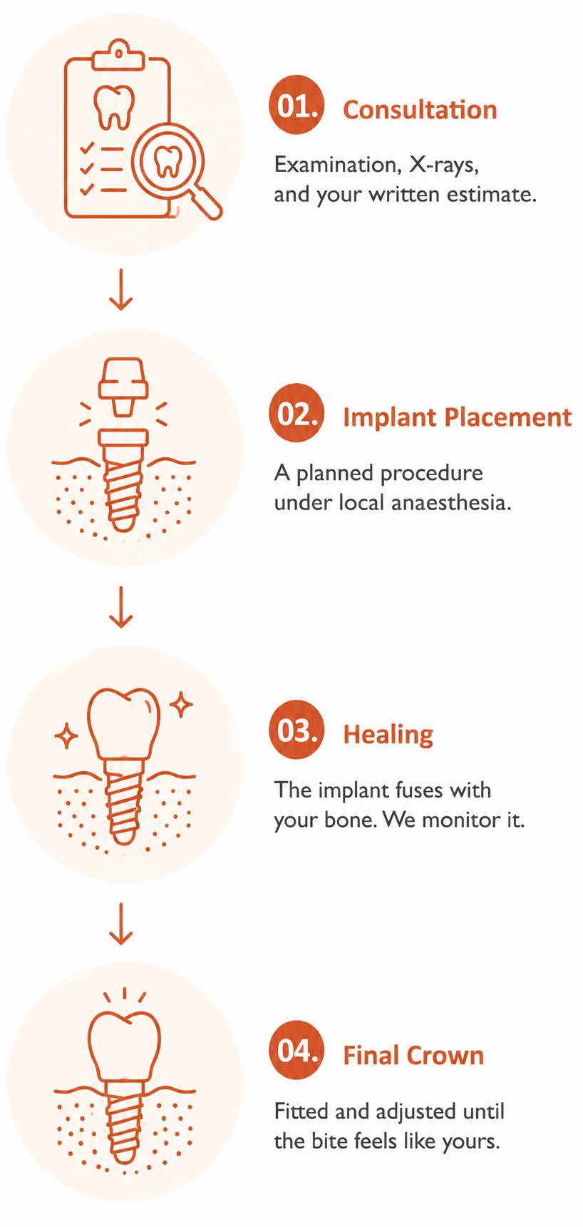 Four-step dental implant process infographic: 01 Consultation, 02 Implant Placement, 03 Healing, 04 Final Crown with corresponding icons and text.