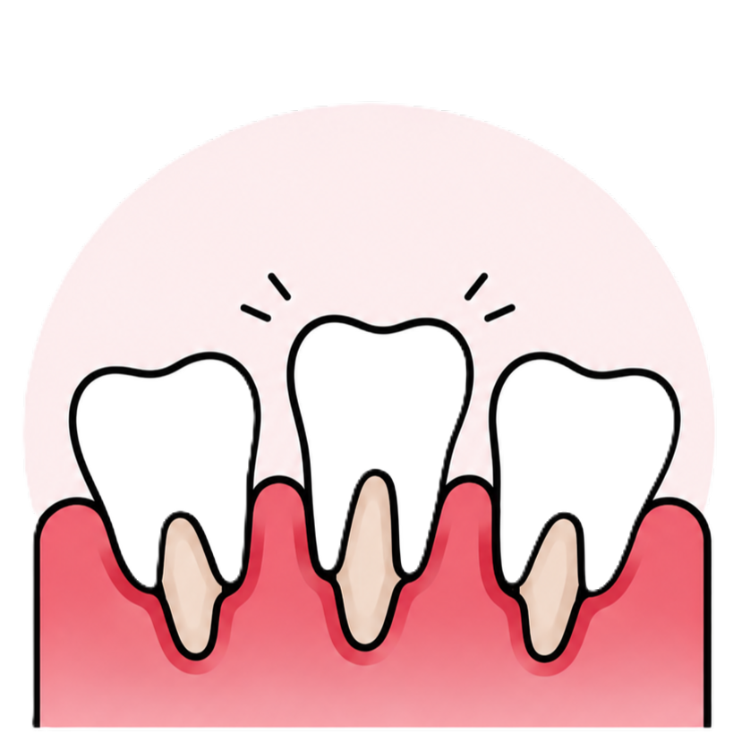 Dental illustration showing three front teeth with red inflamed gums and slight gum recession, central tooth emphasized with small lines suggesting sensitivity or irritation