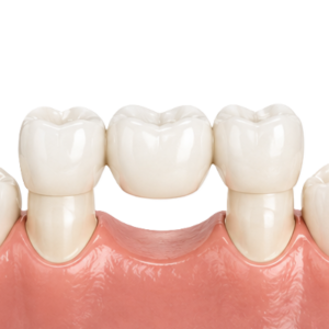 Dental model showing a missing tooth space bridged by adjacent teeth with a dental replacement.