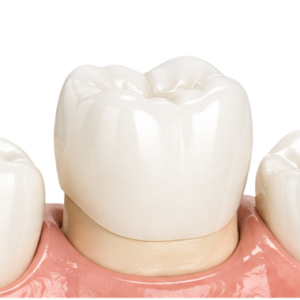 Close-up of a dental model with a white molar crown on pink gum, flanked by neighboring teeth.